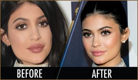 Kylie Jenner posts pic after getting all her lip filler removed